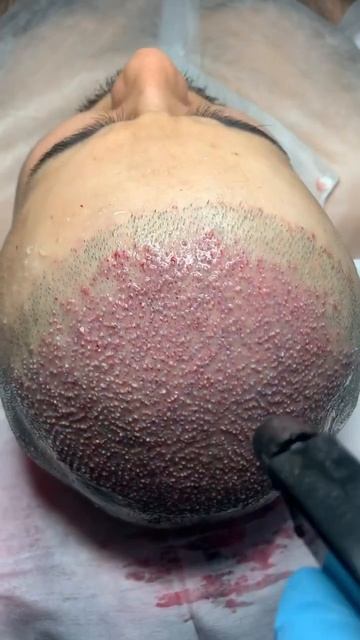 Пересадка волос после операции #пересадкаволос