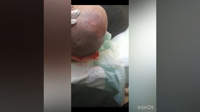 пересадка волос в стамбуле