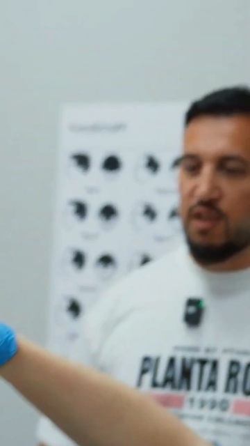 Пересадка волос Денису Цыпленкову #пересадкаволосмос