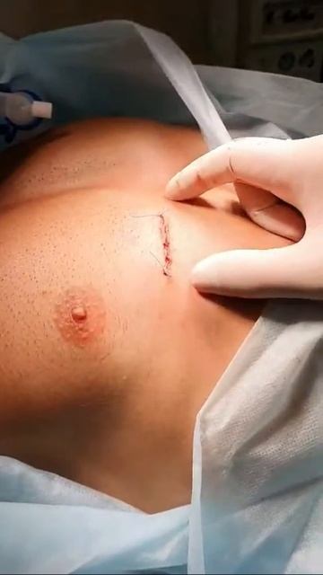 После забора реберного хряща