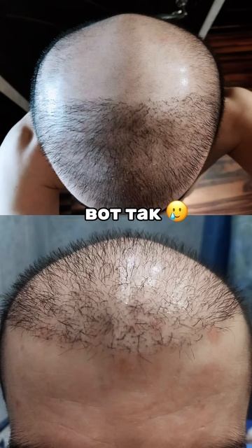 ошибки в пересадке волос. последствия пересадки волос