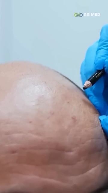 Каха на пересадке волос #кахаисерго #пересадкаволос #п