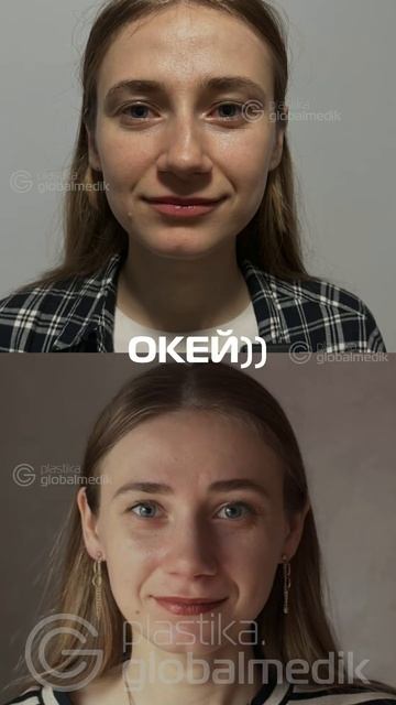 2 месяця после ринопластики #globalmedik #пересадкаволосвту смотреть онлайн