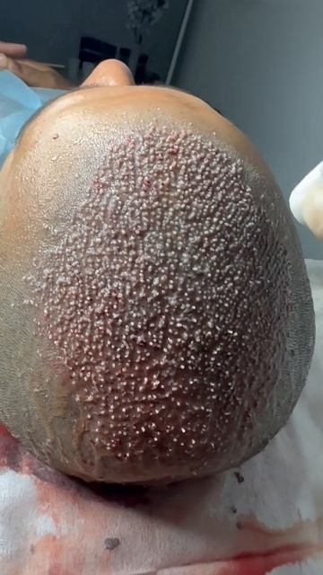 Пересадка волос после отлично операции #пересадкавол?