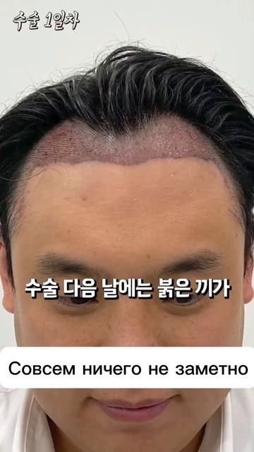 Пересадка волос ДО и ПОСЛЕ . М-зона