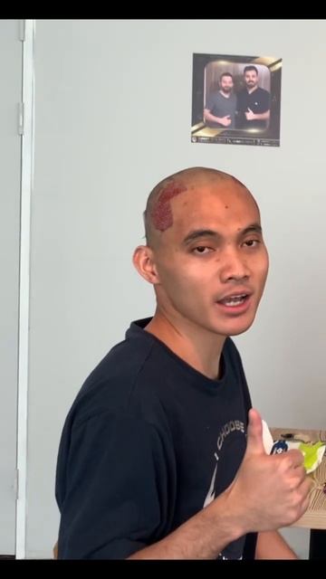 Операция по пересадке волос нашего пациента из Индоне