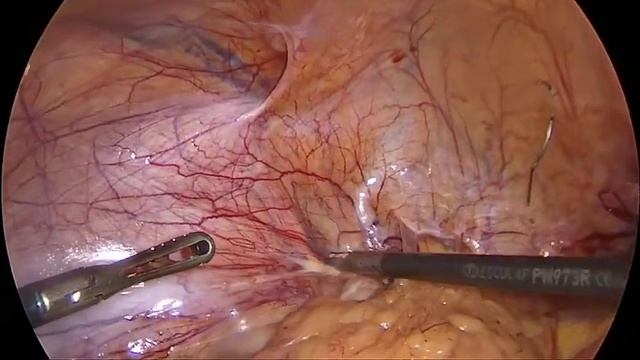 ТАРР с двух сторон