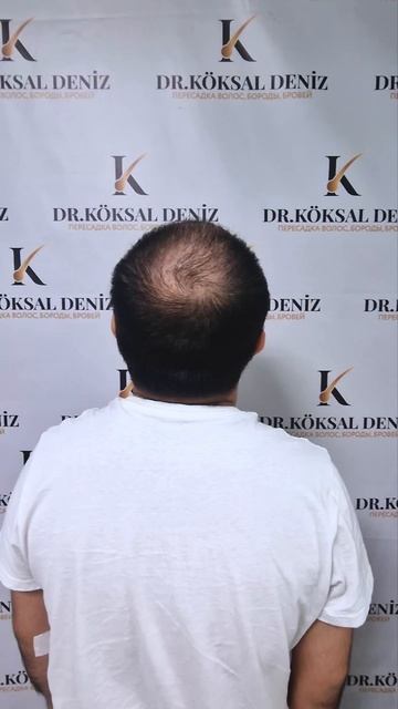 Возможно ли сделать пересадку не сбривая волосы? смотреть онлайн