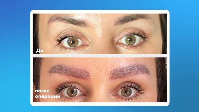 Результат пересадки бровей в Clinicana смотреть онлайн