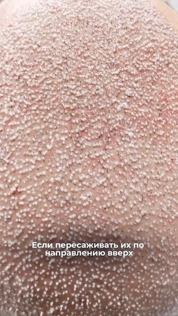 Пересадка волос в Кыргызстане Г.Бишкек 🇰🇬 +996552431234