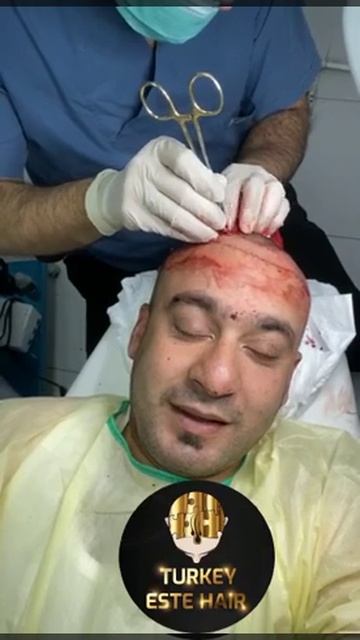 мужская пересадка волос