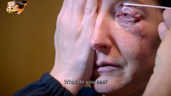 Аномалии тела  сезон  эп  Пересадка зуба в глаз, чтоб сп