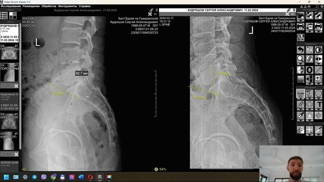 РАЗБОР снимков до/после ЗАМЕТНЫЙ результат - Биомеханика позвоночника