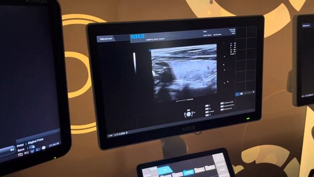 Обзор УЗИ аппаратов: Mindray DC 70 pro, Alpinion Ecube8, SIUI 5800 и SIUI 5300. Щитовидная железа. смотреть онлайн