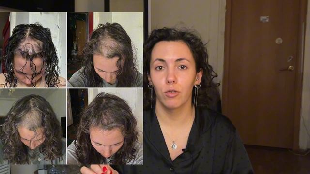 Год с пересадки волос, что хочется сказать? смотреть онлайн