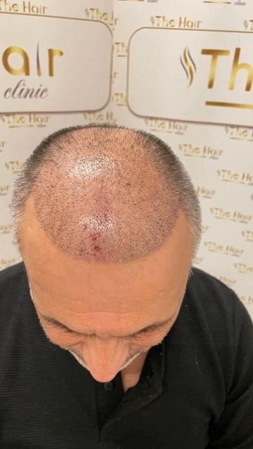 До и после с разницей в 10 дней. Пересадка волос.#турция