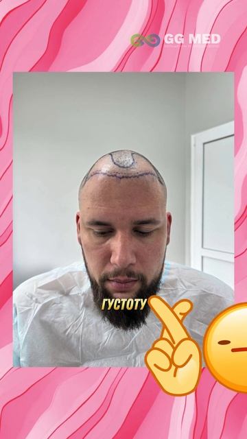 Пересадка волос 214