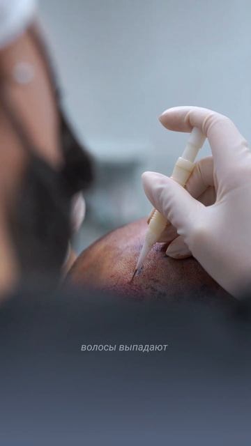 Выпали волосы после пересадки... Шоковое выпадение вол смотреть онлайн