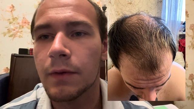 Пересадка волос | 4 месяца после пересадки волос смотреть онлайн