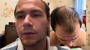 Пересадка волос | 4 месяца после пересадки волос