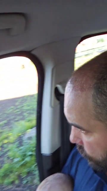 пересадка волос в Уфе 60 день после операций результат