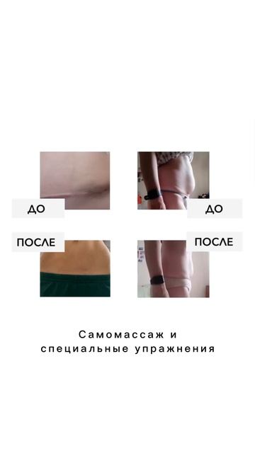Как убрать «валик» наш швом КС без операции? смотреть онлайн