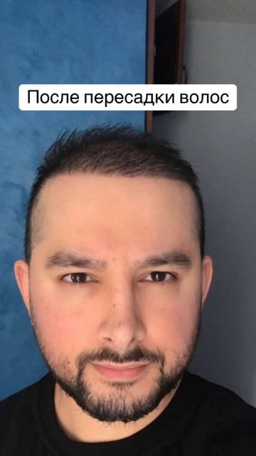 До и после пересадки волос в Турции 🇹🇷 #пересадкавол смотреть онлайн