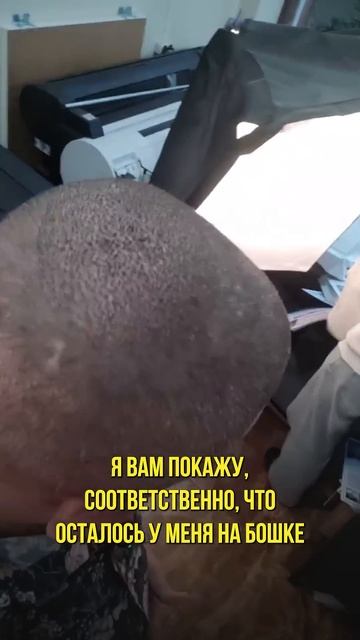 Пересадка волос. Неделя после операции смотреть онлайн