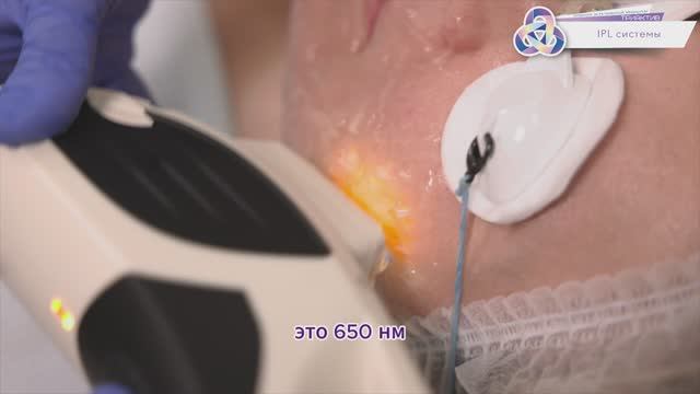 IPL терапия
