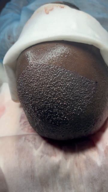 Последняя операция по пересадке волос в 2023 году #перес