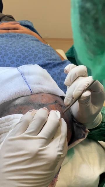 профессиональная пересадка волос #пересадкаволос смотреть онлайн