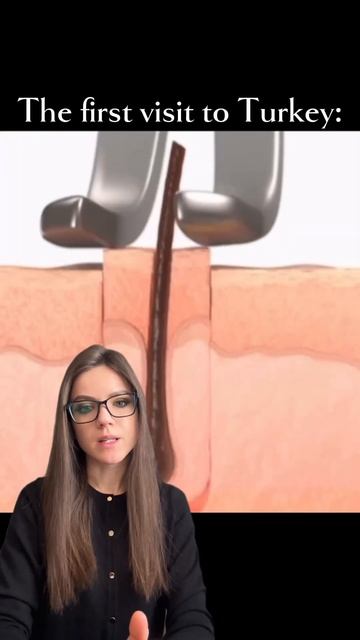 Как происходит пересадка волос методом Fue