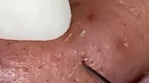 Прыщи / Огромные прыщи / Релакс с акне / Выдавливание пр