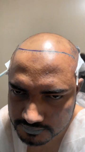 Пересадка волос после операции #пересадкаволос