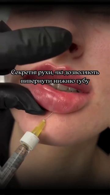 Выворот нижней губы во время увеличения в технике пло?