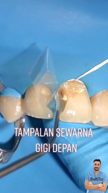 حشو تجميلي للاسنان الامامية|composite restoration of anterior teeth композитная реставрация передни смотреть онлайн