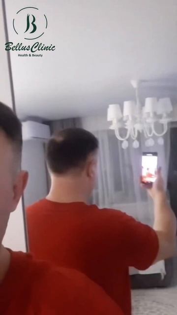 Результат пересадки волос на большое облысение