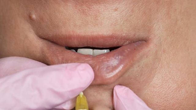 Увеличение губ| Техника плоский бант| Как добиться пло смотреть онлайн