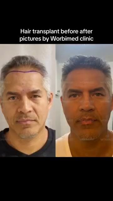 Пересадка волос в Стамбуле +79390002507 WhatsApp - бесплатная ко смотреть онлайн