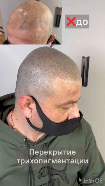 Исправление чужой работы, перекрытие трихопигментации. Botched scalp micropigmentation cover up смотреть онлайн