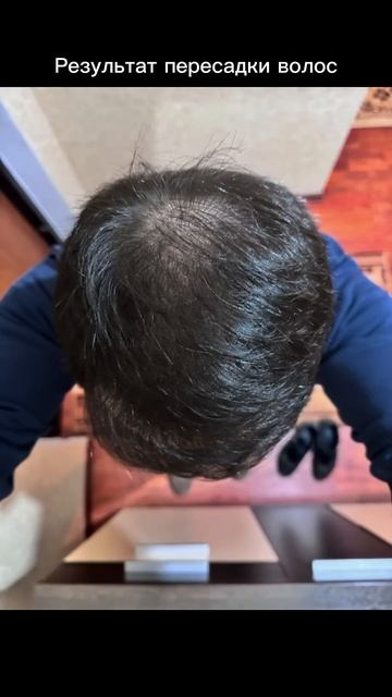 Пересадка волос до и после смотреть онлайн