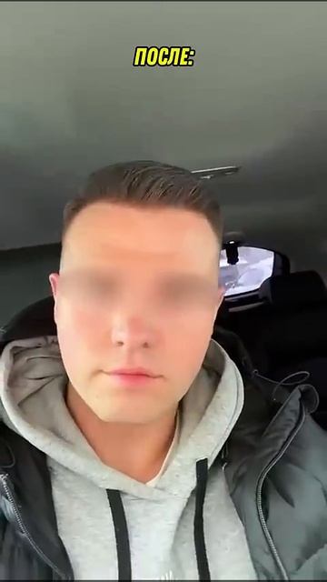 ПЕРЕСАДКА ВОЛОС ДО И ПОСЛЕ 197 смотреть онлайн