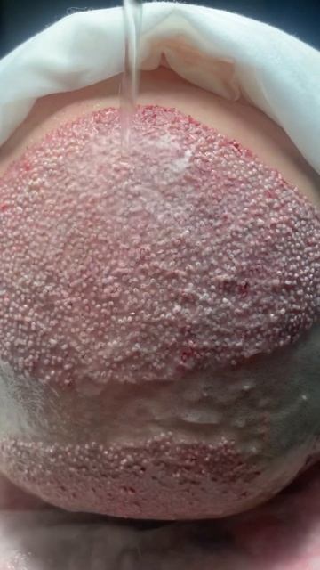 Пересадка волос в Москве #пересадкаволос #пересадкабр смотреть онлайн