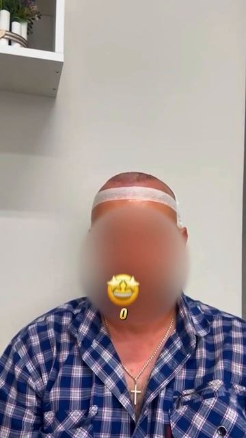 ИСПРАВЛЯЕМ ОШИБКИ ПОСЛЕ ДРУГИХ #пересадкаволос