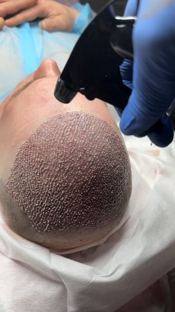 Пересадка волос после отлично операции #пересадкавол?