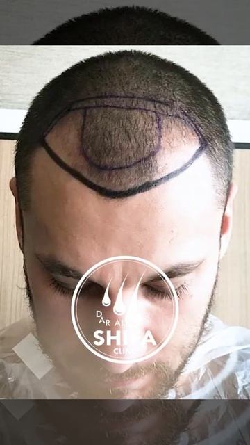 Опыт одного из наших клиентов по пересадке волос. Запи смотреть онлайн