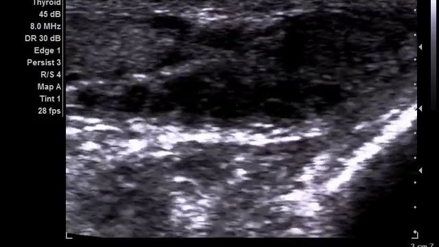 Образование в проекции семенного канатика-1.avi смотреть онлайн