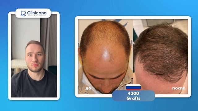 Пациент из России через год после пересадки волос в кл смотреть онлайн