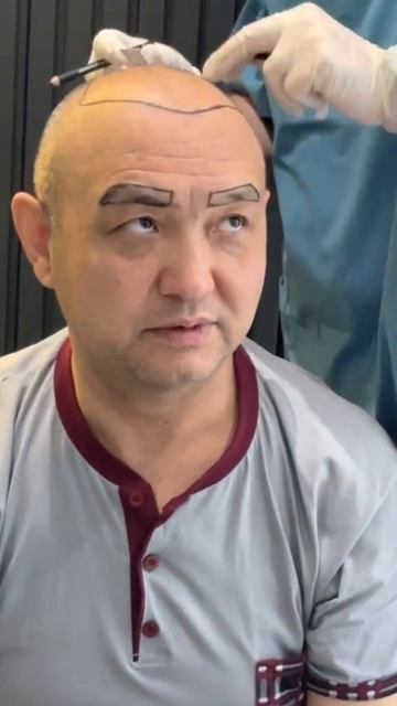 Eyebrow transplant before and after l Пересадка бровей #eyebrowtransplant #пере смотреть онлайн