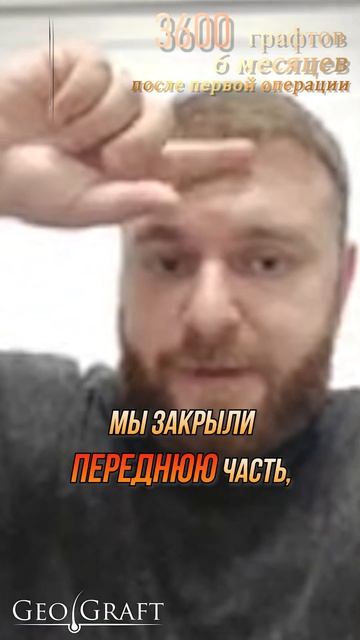 GeoGraft | Пересадка волос отзыв смотреть онлайн